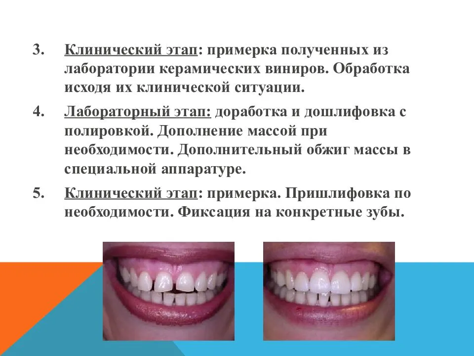 Вредны ли виниры для зубов? – статьи стоматологической клиники «доктор мартин»