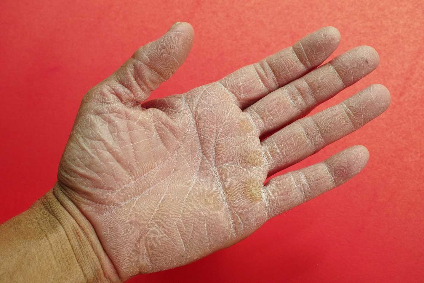 Шелушение кожи на руках: патология или временный дискомфорт