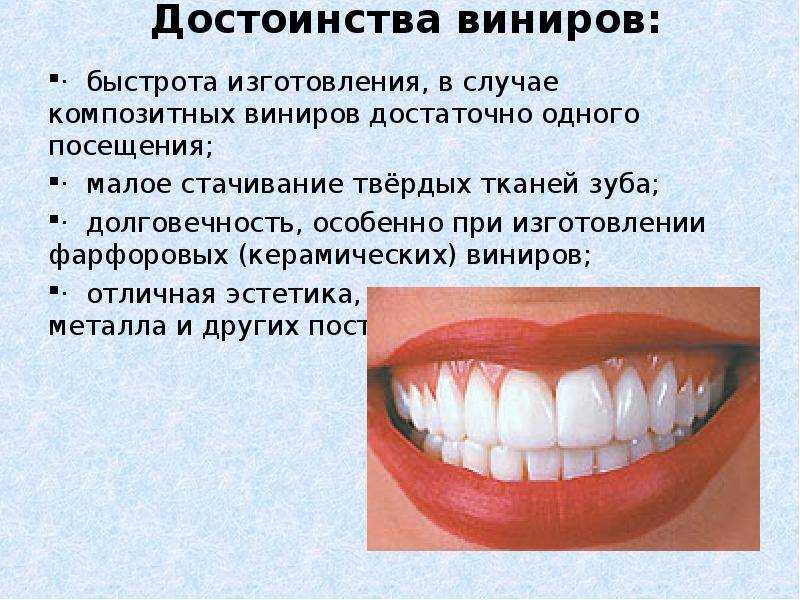 Виниры на зубы: что это такое и как их ставят
