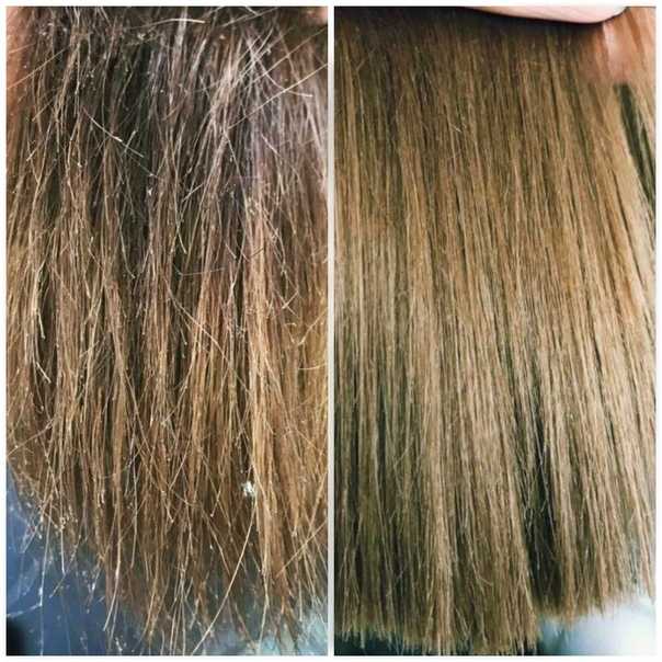 Выпадение волос у женщин: причины и лечение | университетская клиника