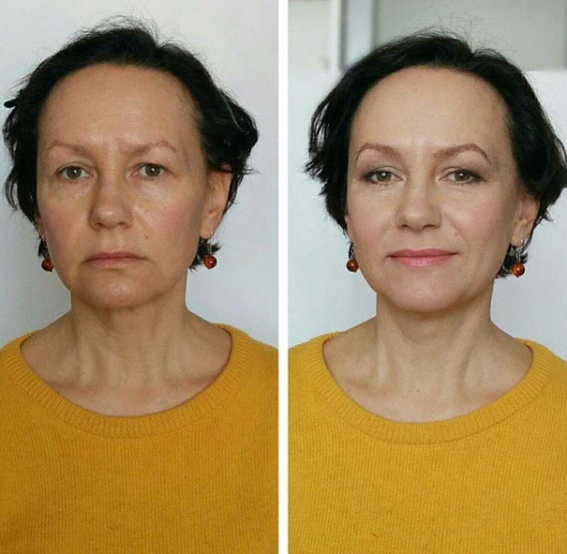 фото до и после подтяжки кожи